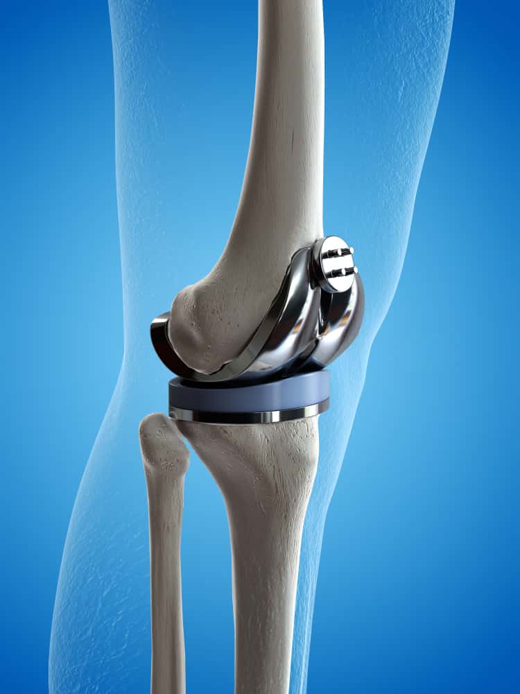 Arthroplasty